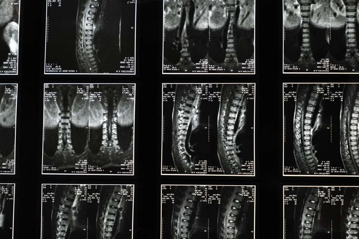 A clinician reviewing a post-surgical spine x-ray showing fusion hardware.