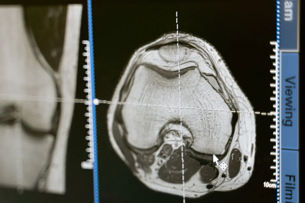 An X-ray showing spinal cord stimulator leads positioned in the epidural space along the spine.
