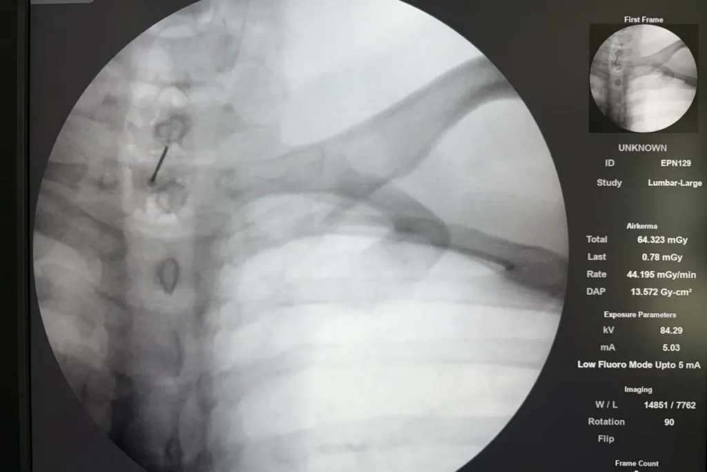 Fluoroscopic image confirming needle position during an epidural steroid injection.