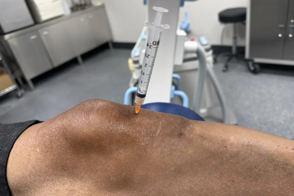 Image-guided knee joint injection, the needle entering the knee beside the imaging equipment.