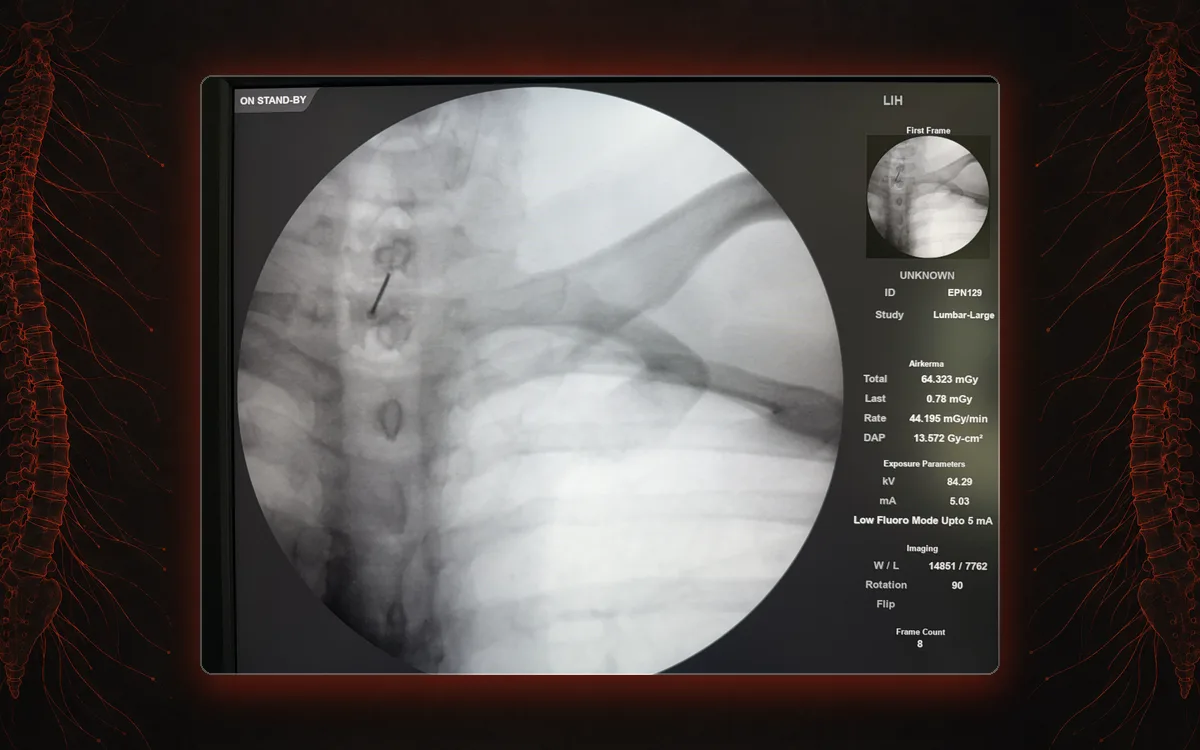 Fluoroscopy confirming needle position during an epidural steroid injection at our St. Louis clinic.