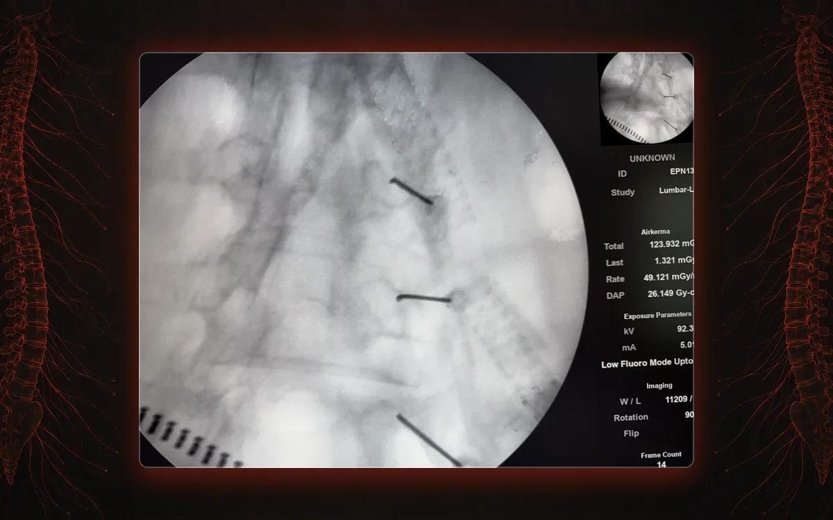 Fluoroscopy of three radiofrequency needles along the lumbar medial branch nerves during radiofrequency ablation.