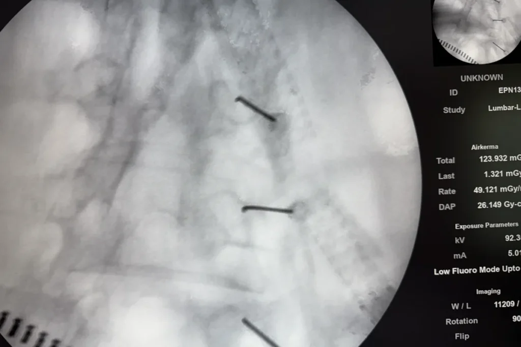 Fluoroscopic view of three radiofrequency needles placed along the lumbar medial branch nerves during radiofrequency ablation.